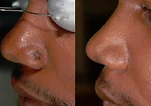 nose tattoo removal before and after