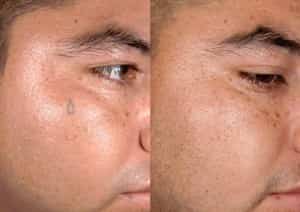 Face Tattoo Tear Removal Before and after
