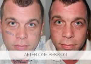 Face Tattoo Removal after one session