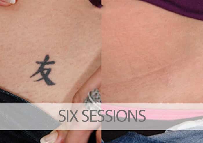 Before and after six laser tattoo removal sessions