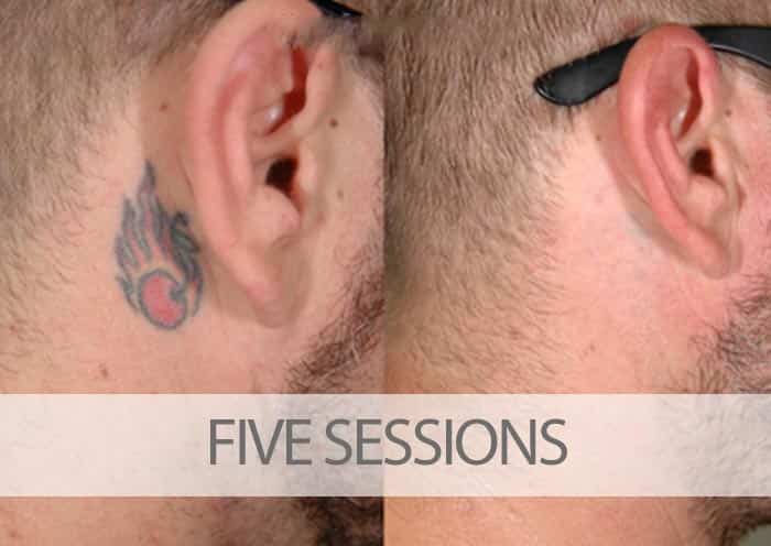 Before and after five laser tattoo removal sessions