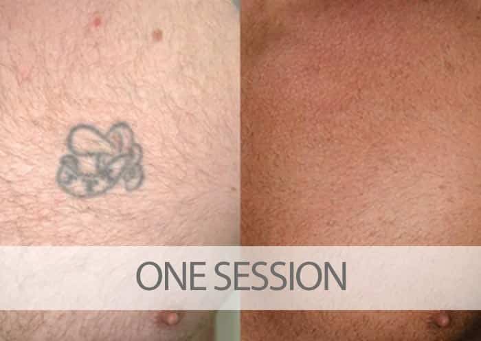 Before and after one laser tattoo removal session