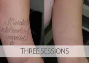 Before and after three sessions of laser tattoo removal