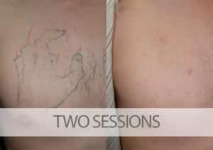 Tattoo Removal Before and After Picture