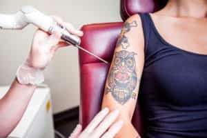 Woman having her owl tattoo removed by a laser tattoo removal machine.