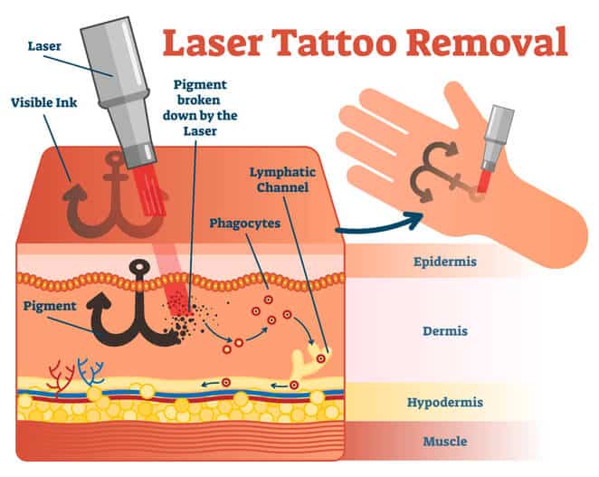 Diagram showing how laser tattoo removal eliminates visible ink pigments from the dermis layer of skin.