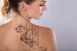 Woman with a back tattoo that's fading gradually after four sessions with a tattoo removal laser.