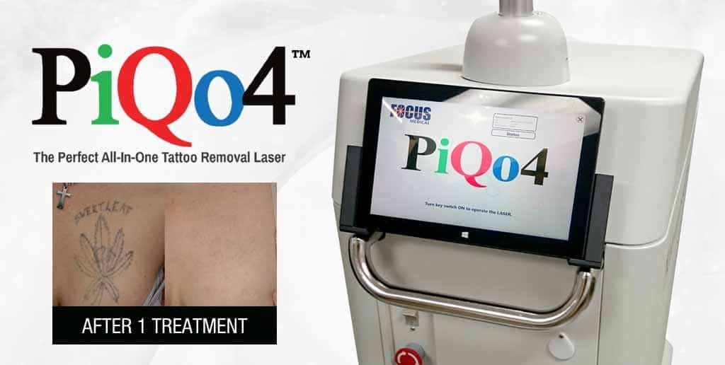 PiQo4 Laser Tattoo Removal with One-Week after Treatment Example.
