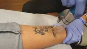 Black Into Tattoo Being Removed