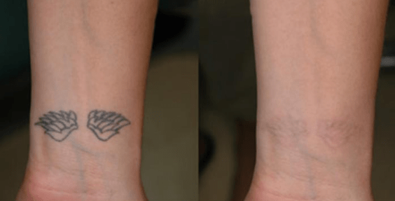 wrist tattoo and wrist tattoo removal