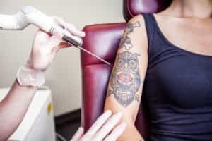 Laser Tattoo Removal session