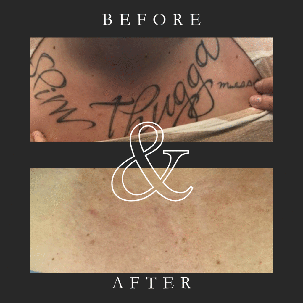 Before and after laser tattoo removal on upper arm, treated by Eraditatt in Tampa