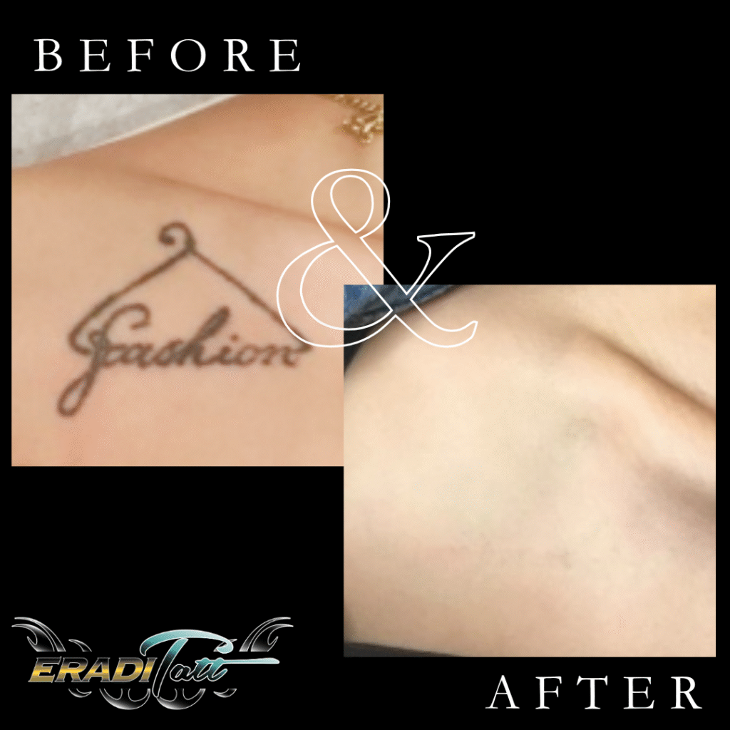 Before and after laser tattoo removal behind the ear with PiQo4 laser at Eraditatt, serving Tampa, St. Petersburg, Palm Harbor, Bradenton/Sarasota, and Orlando