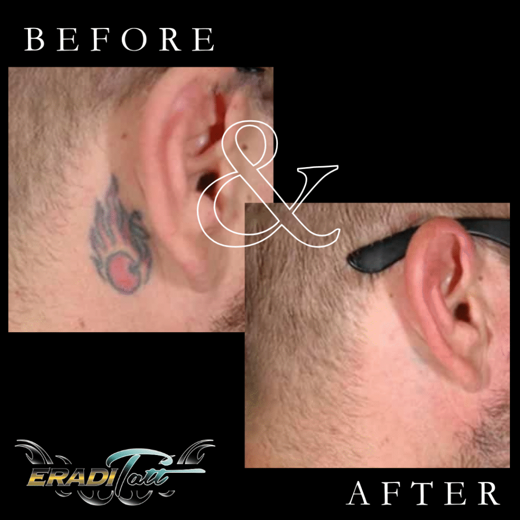 Before and after laser tattoo removal on shoulder with PiQo4 laser at Eraditatt, serving Tampa, St. Petersburg, Palm Harbor, Bradenton/Sarasota, and Orlando