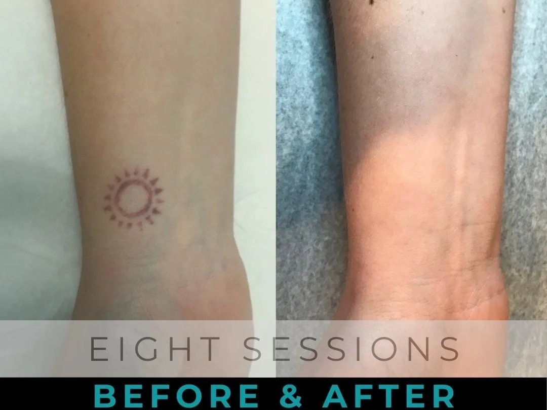 Red sun tattoo on a wrist before laser removal and the same wrist with the ink cleared after eight PiQo4 sessions at EradiTatt