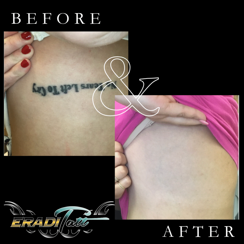 Before and after laser tattoo removal on ribs with PiQo4 laser at Eraditatt, serving Tampa, St. Petersburg, Palm Harbor, Bradenton/Sarasota, and Orlando