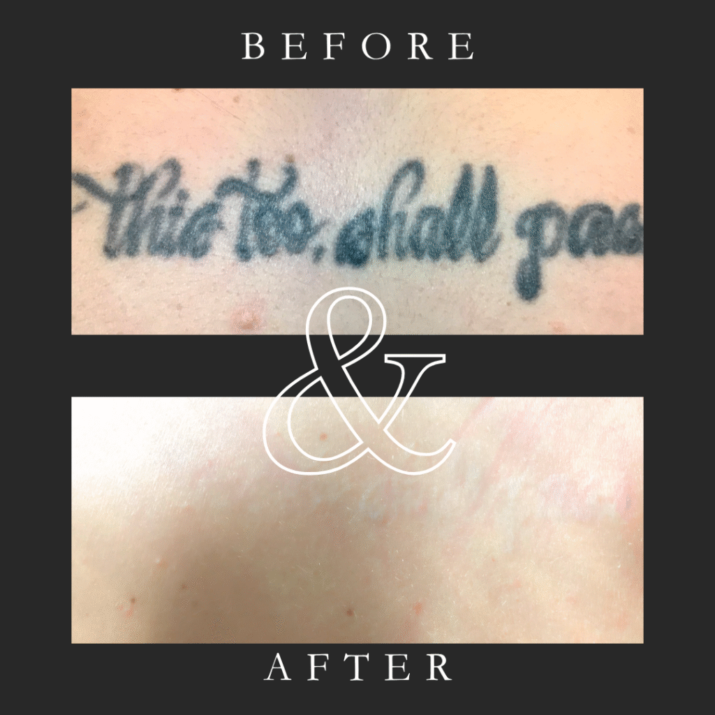 Before and after laser tattoo removal on the arm with PiQo4 laser at Eraditatt, serving Tampa, St. Petersburg, Palm Harbor, Bradenton/Sarasota, and Orlando