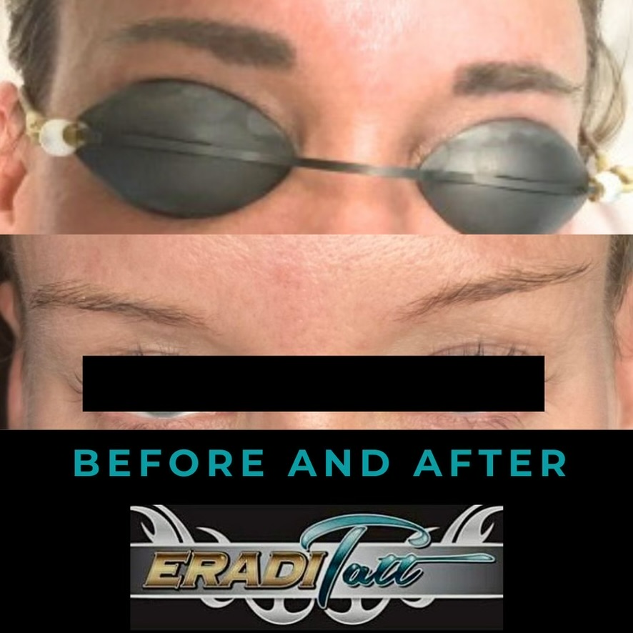 Before and after results of laser tattoo removal with Eraditatt using PiQo4 technology