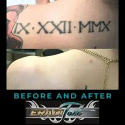 Laser Tattoo Removal for Black and Red Ink