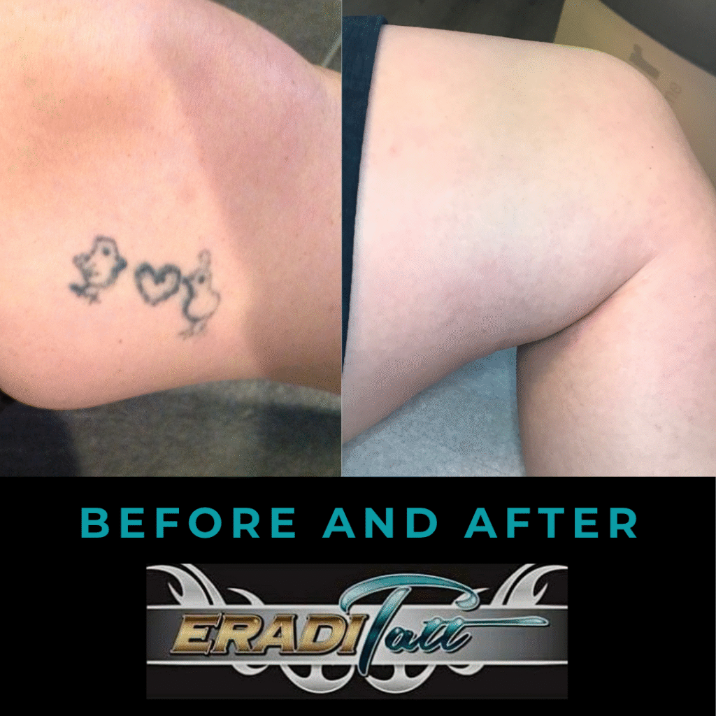 Before, during, and after photo of thigh tattoo removal using PiQo4 laser at Eraditatt.