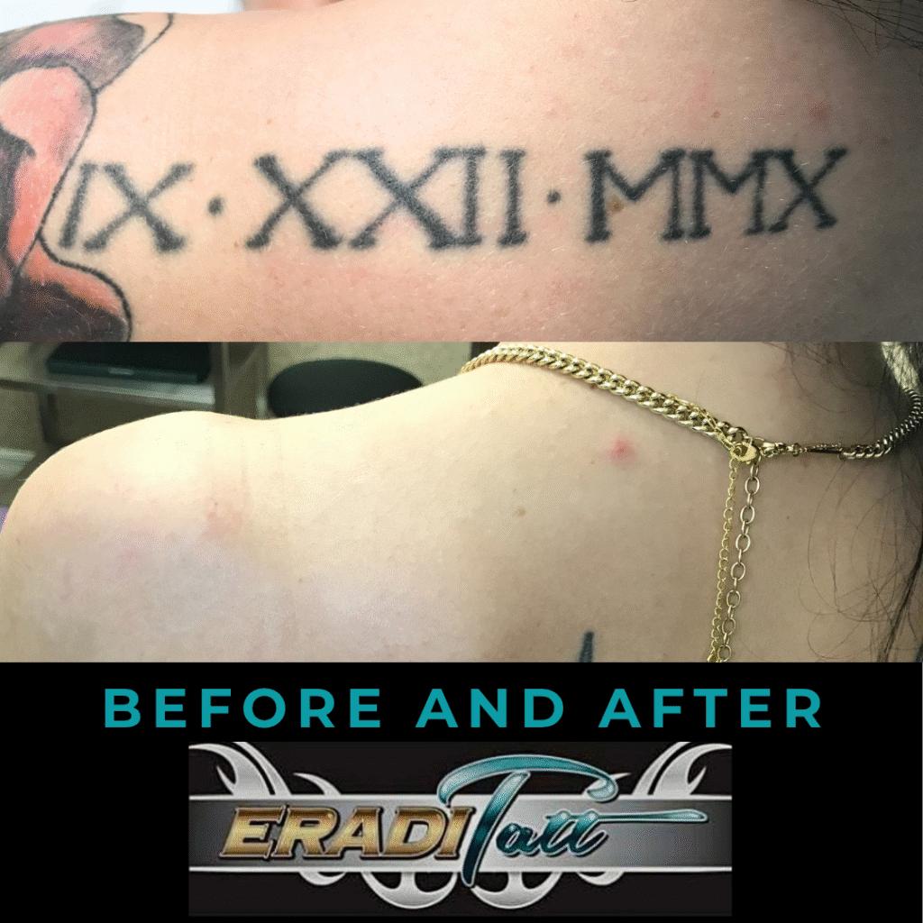 Before and after laser tattoo removal on upper back using PiQo4 technology at Eraditatt.