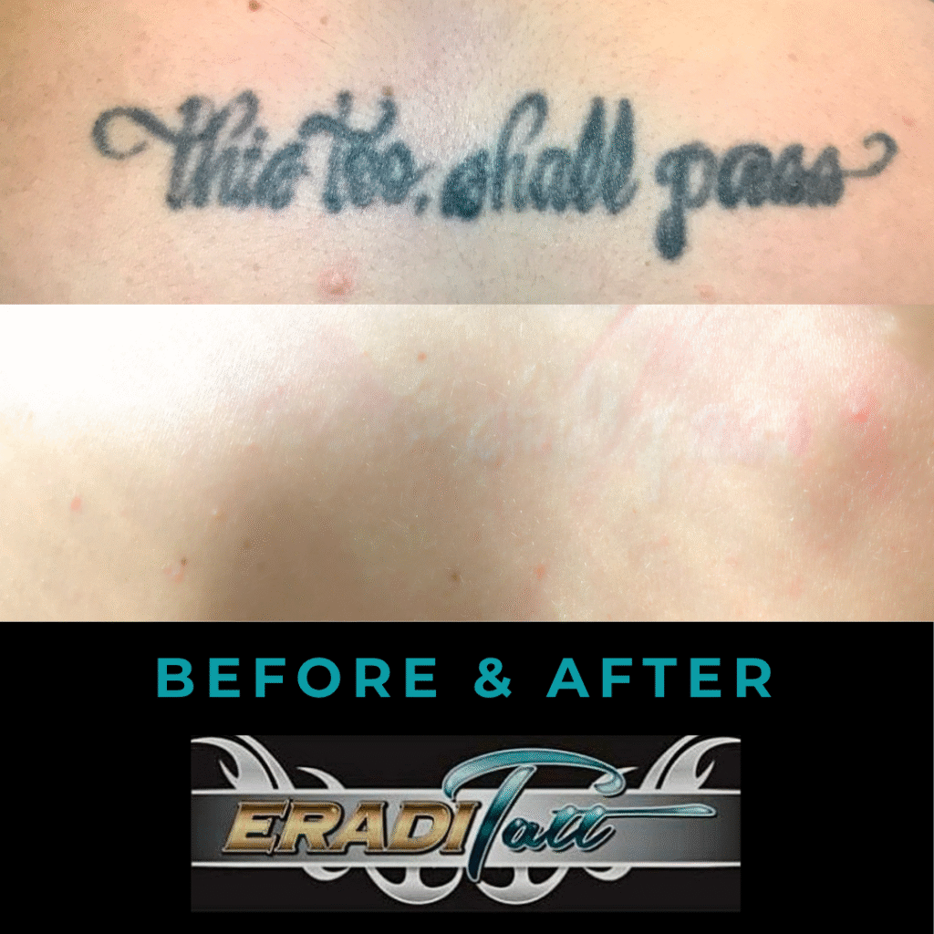 Before and after photo of back tattoo removal using PiQo4 laser at Eraditatt.