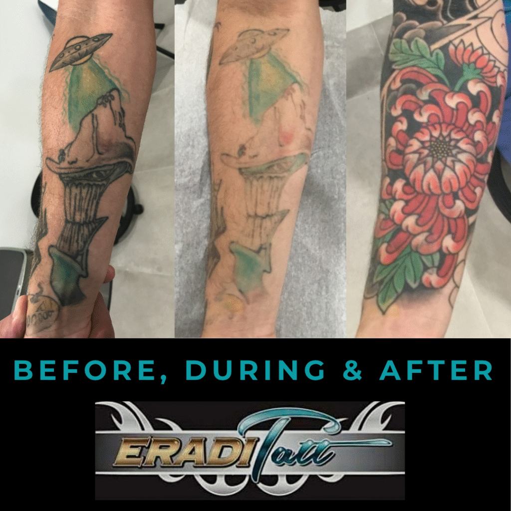 Before, during, and after color tattoo removal on upper arm using PiQo4 laser at Eraditatt.