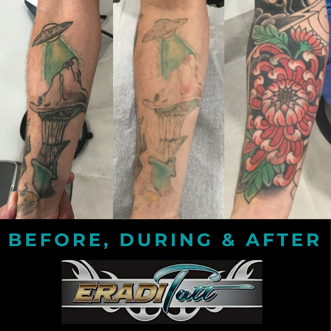 Removing Cover-Up Tattoos: How EradiTatt Makes the Fade Plan Work