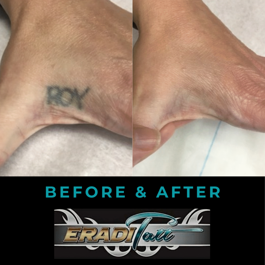 Progress photos of hand tattoo removal at Eraditatt, featuring PiQo4 laser fading results.