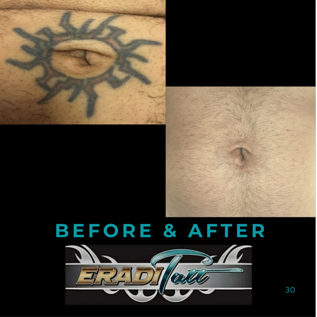 “Before and after photo of belly tattoo removal using PiQo4 laser at Eraditatt
