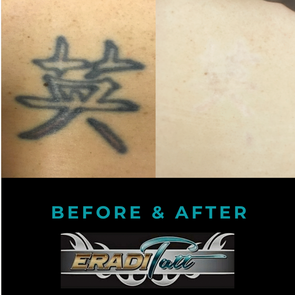 Before and after laser tattoo removal on upper back using PiQo4 technology at Eraditatt.