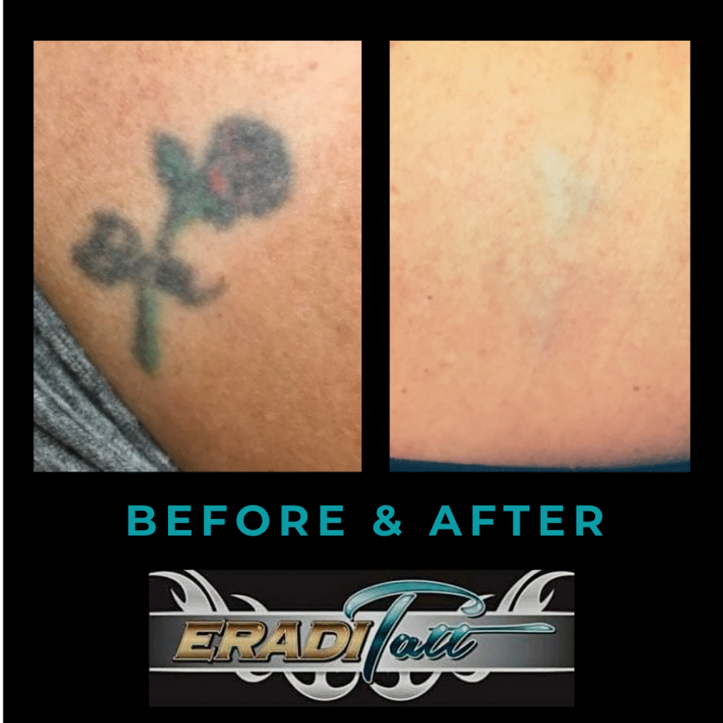 Before, during, and after of small color tattoo removal using the PiQo4 laser at Eraditatt.