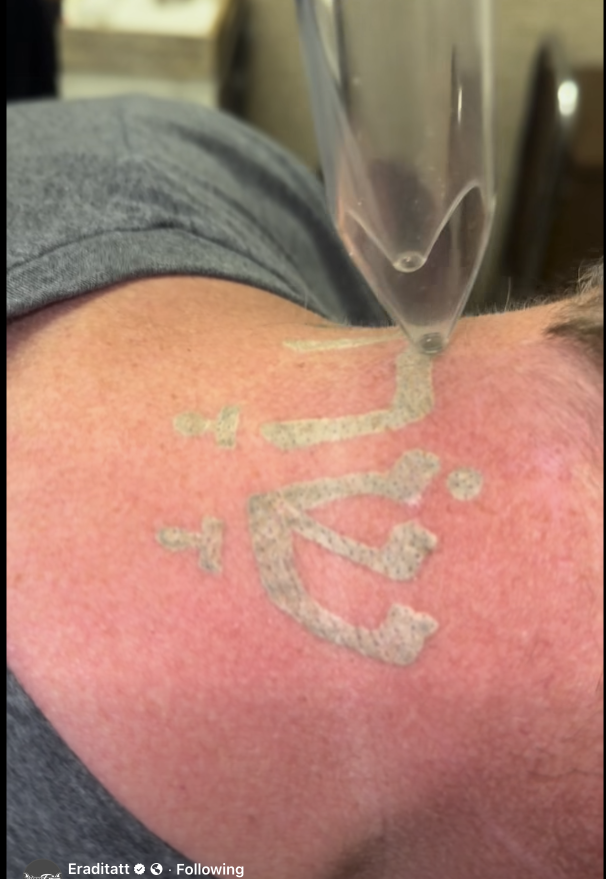 Frosting during PiQo4 laser tattoo removal at Eraditatt clinic in Florida