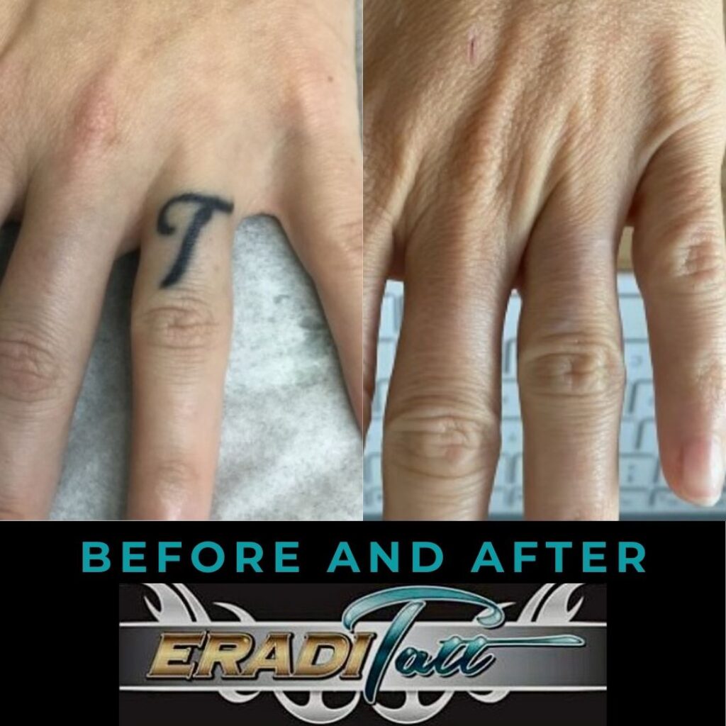 Ring Finger Before and After photo