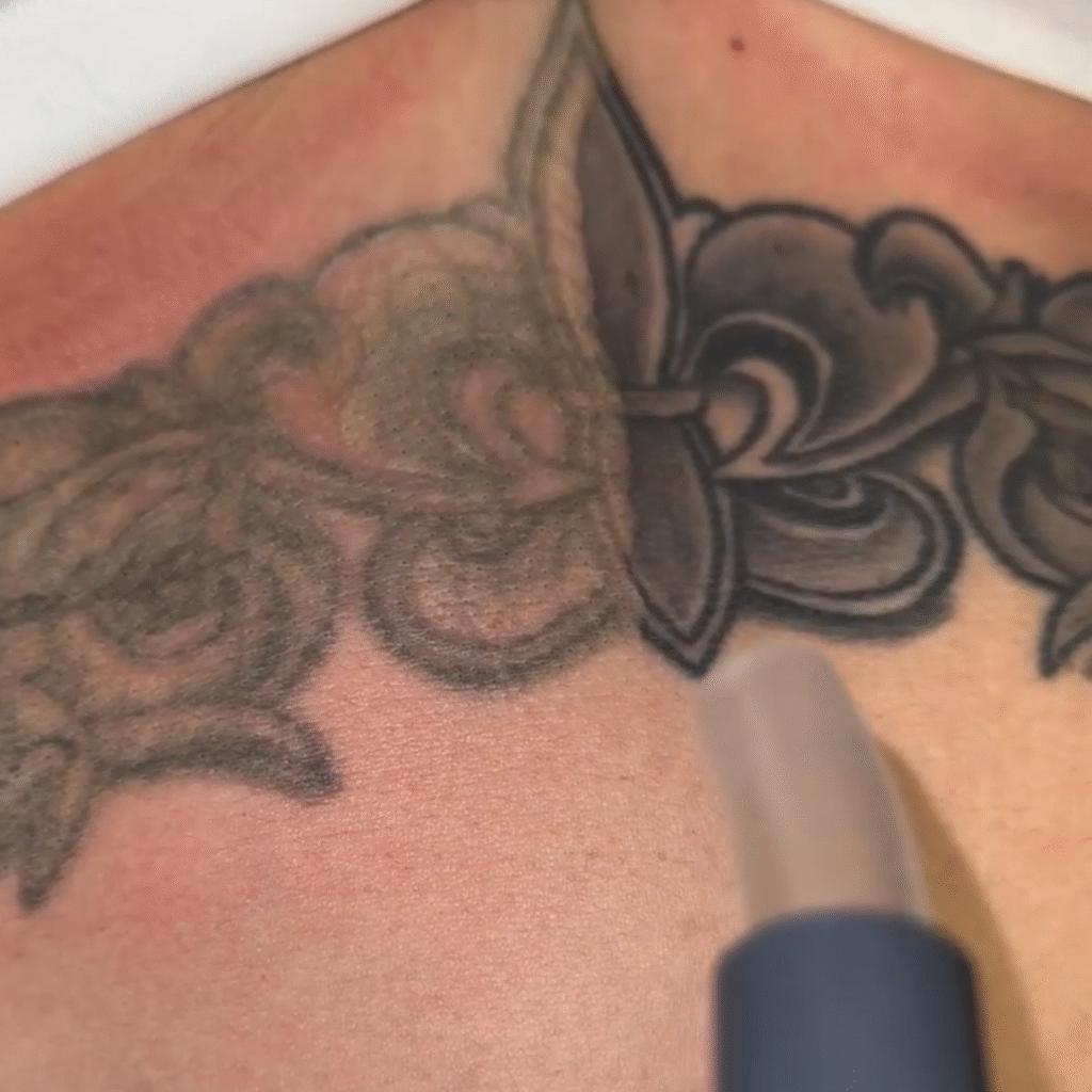 Laser specialist performing tattoo removal using PiQo4 technology at EradiTatt clinic in Tampa