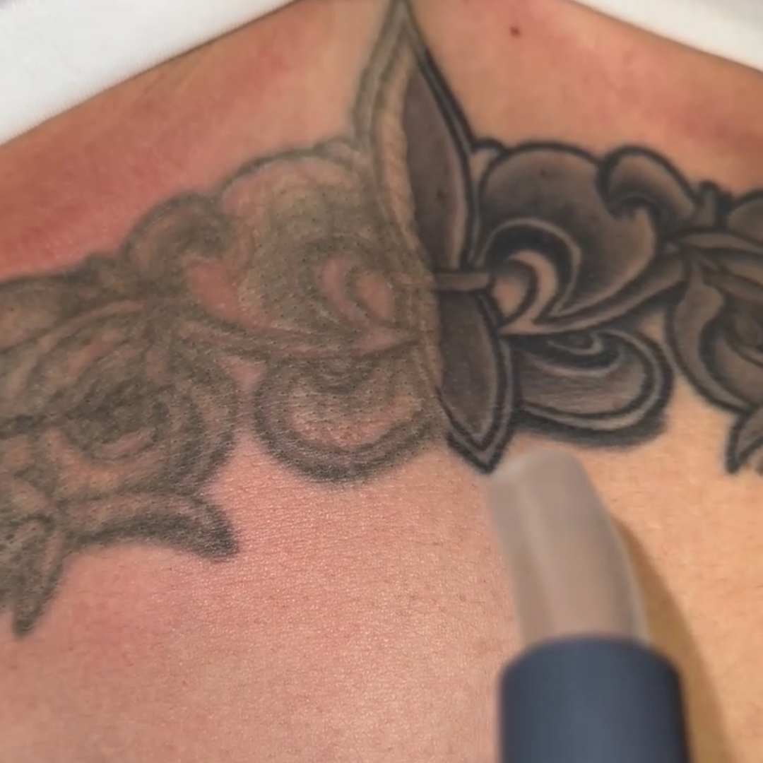 Laser specialist performing tattoo removal using PiQo4 technology at EradiTatt clinic in Tampa