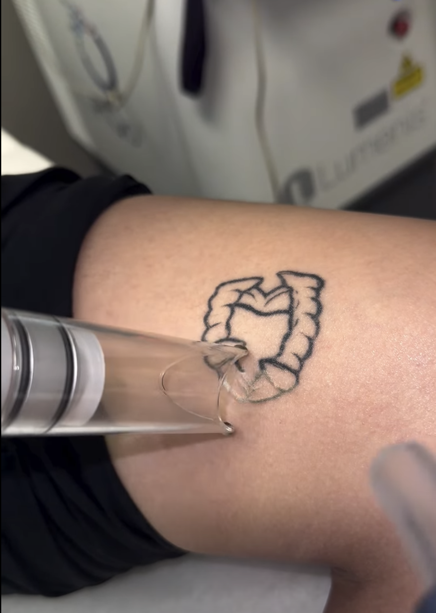 Laser specialist performing tattoo removal with PiQo4 system at EradiTatt clinic during the fall season