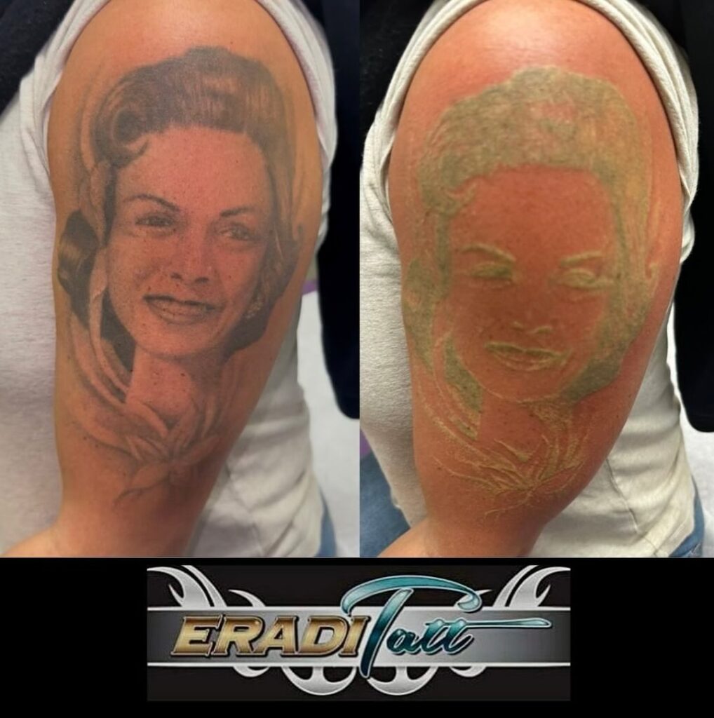 Frosting effect after a first laser tattoo removal session using the PiQo4 laser at Eraditatt.