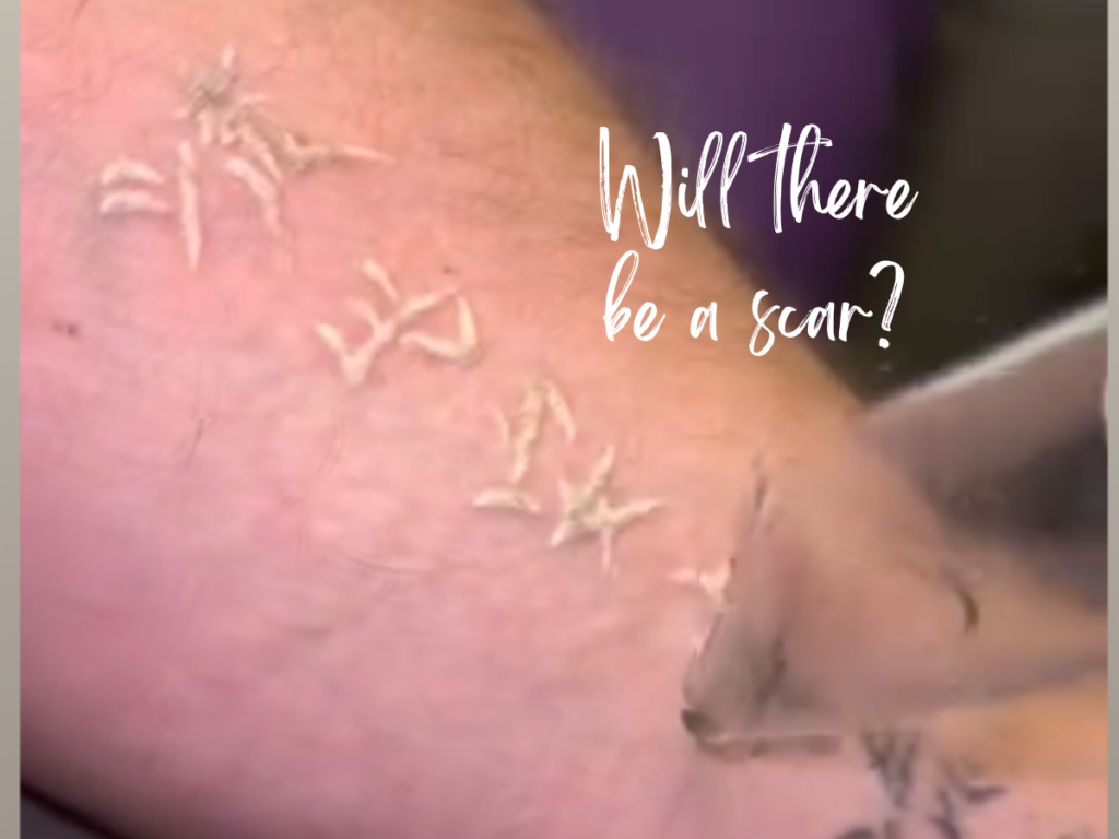 Laser technician removing tattoo with PiQo4 laser to minimize scarring during tattoo removal treatment.