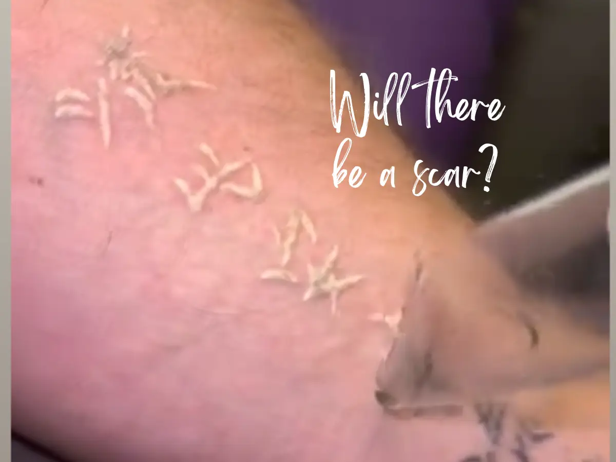 Laser technician removing tattoo with PiQo4 laser to minimize scarring during tattoo removal treatment.