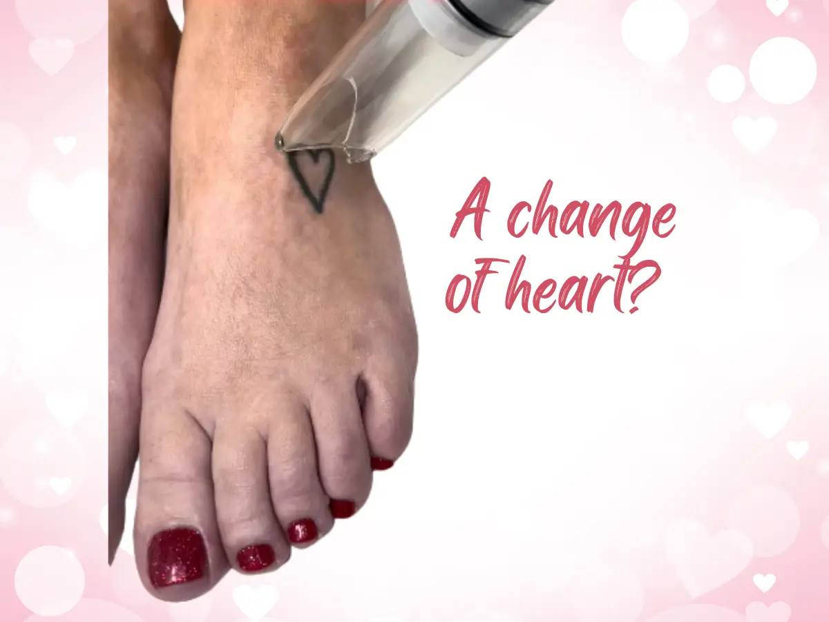 Laser tattoo removal of a small heart tattoo on the foot at Eraditatt.