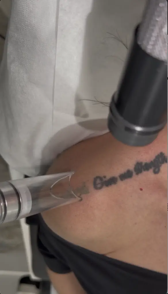 Dense shoulder tattoo removal using PiQo4 laser at EradiTatt