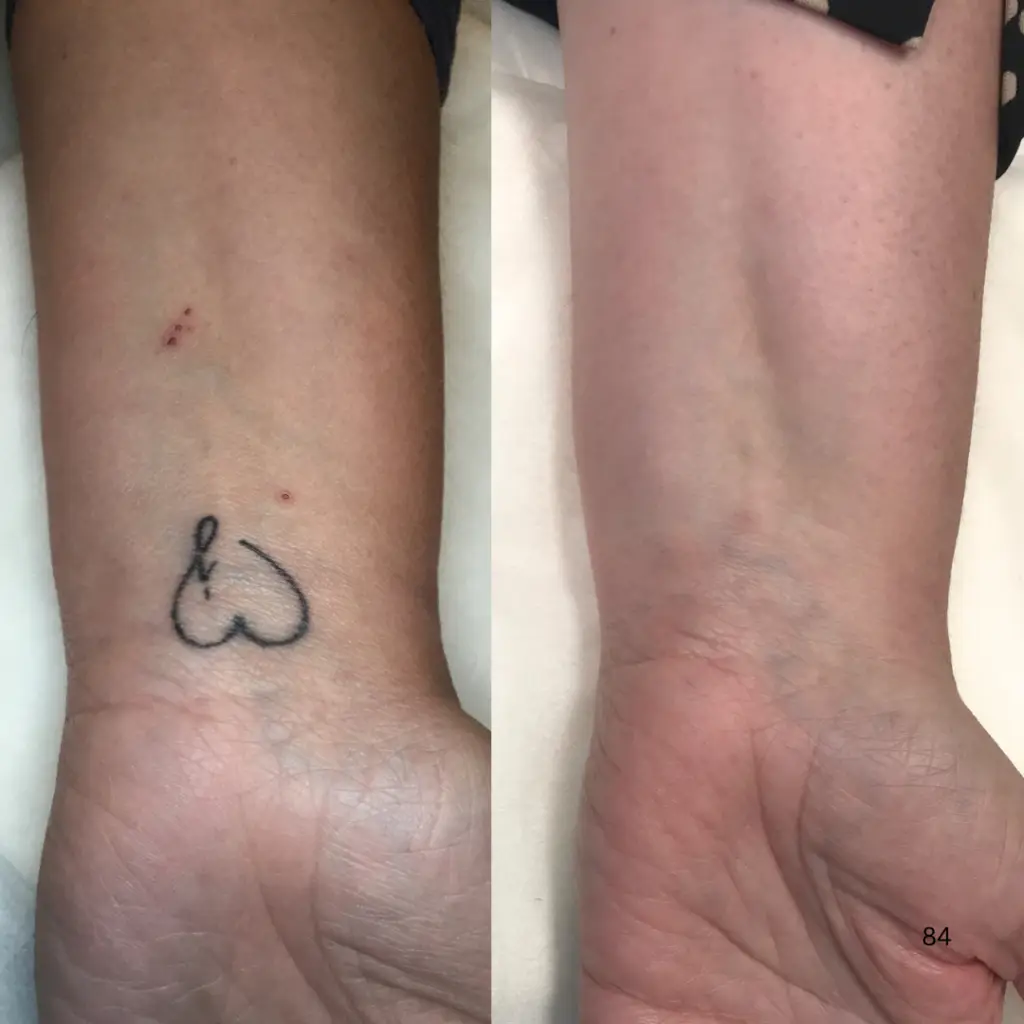 Before and after wrist tattoo removal using PiQo4 laser at EradiTatt