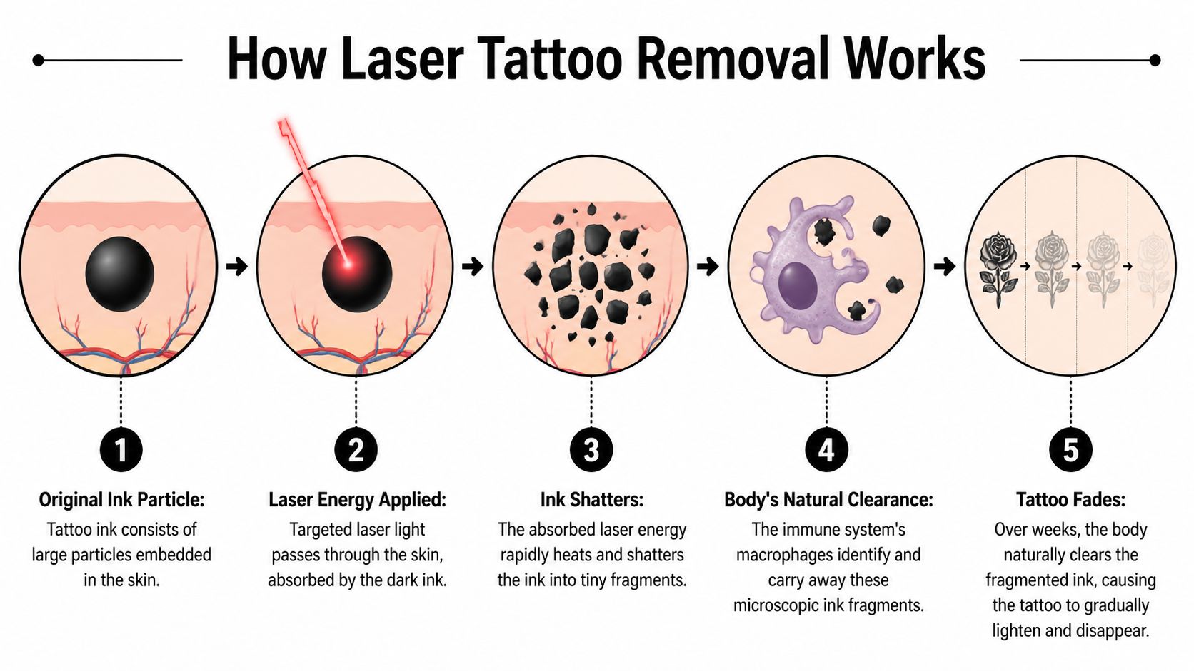 An infographic illustrating the five steps of laser tattoo removal from ink shattering to gradual fading.