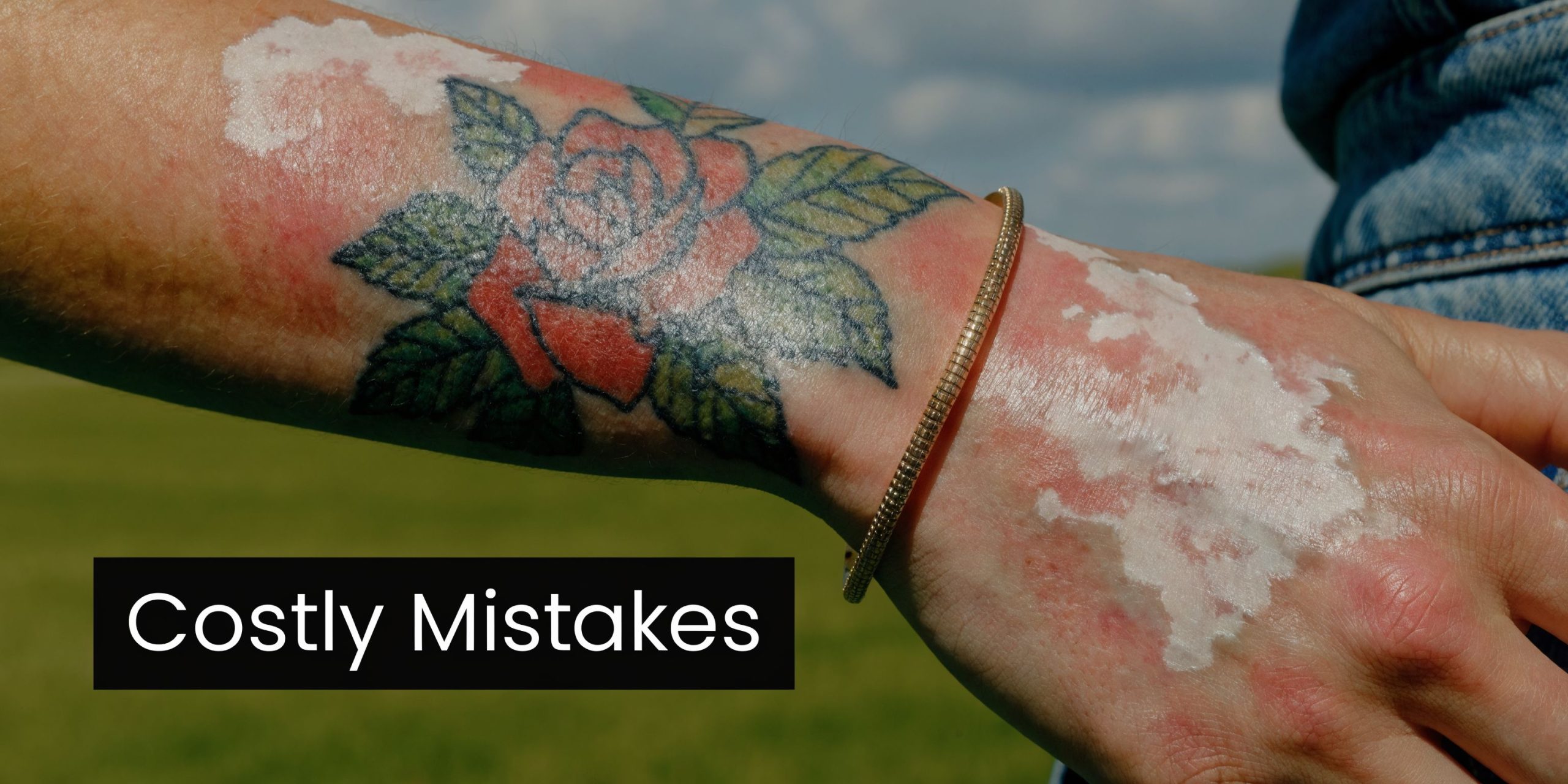 A person with a rose tattoo and visible vitiligo skin condition on their arm and hand.