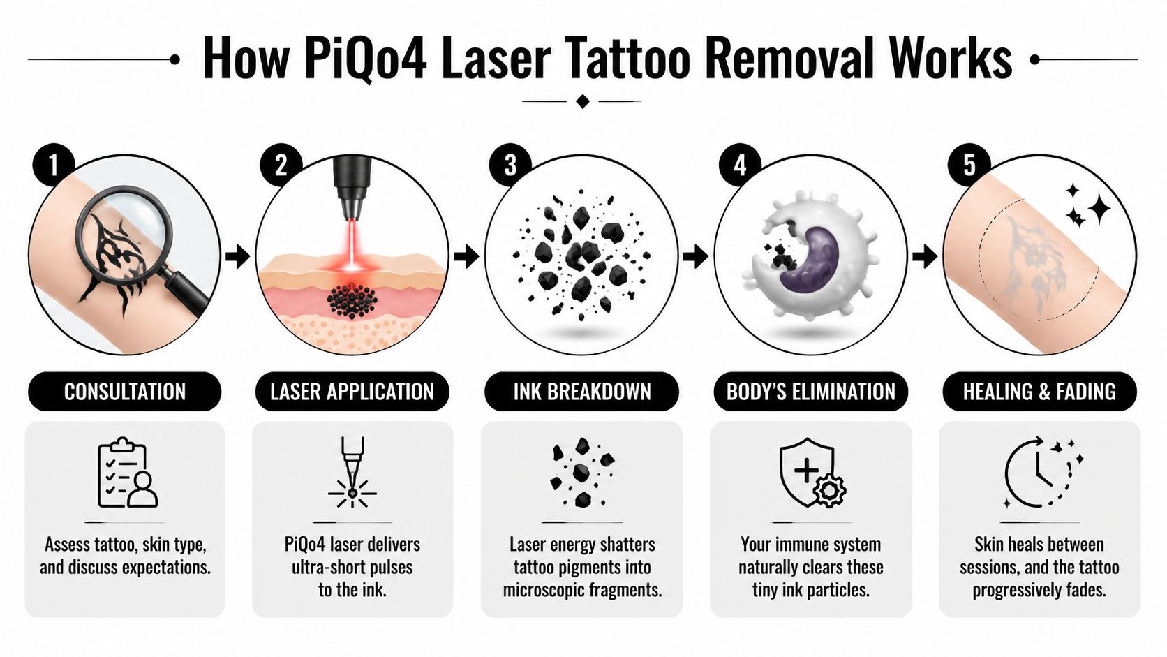 A five-step infographic illustrating the process of PiQo4 laser tattoo removal from initial consultation to final fading.