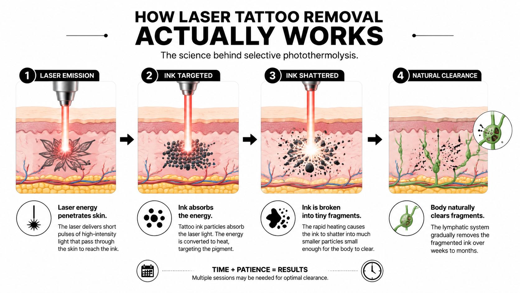 An infographic showing the four-step biological process of how laser technology removes tattoo ink from the skin.
