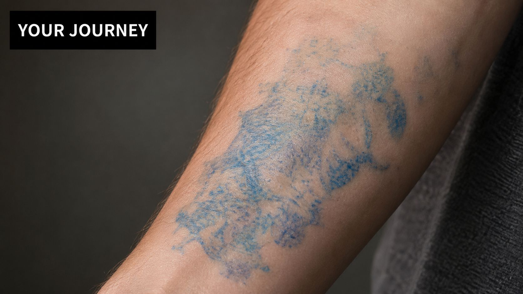 A close-up view of a forearm showing the progress of blue ink laser tattoo removal treatment.