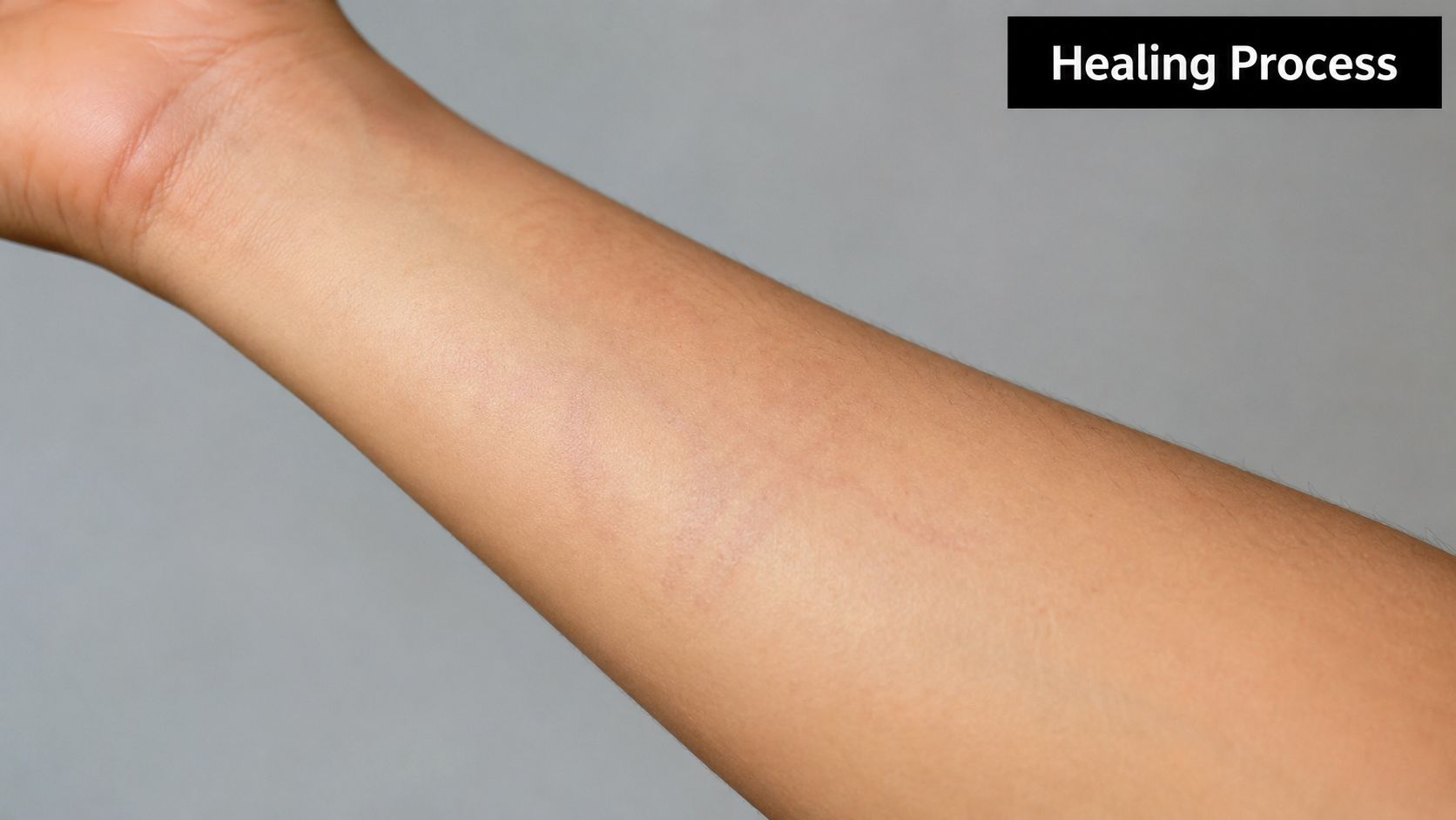 A close-up view of a person's forearm showing skin texture during the laser tattoo removal healing process.