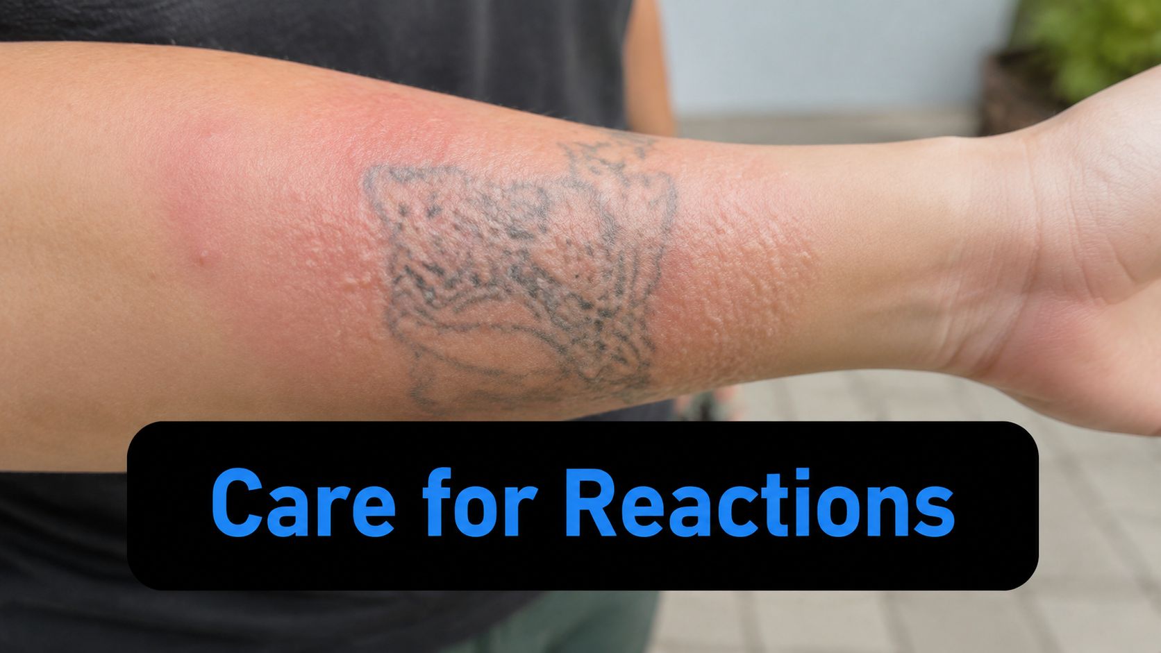 A close-up view of an irritated arm skin reaction following a professional laser tattoo removal session.